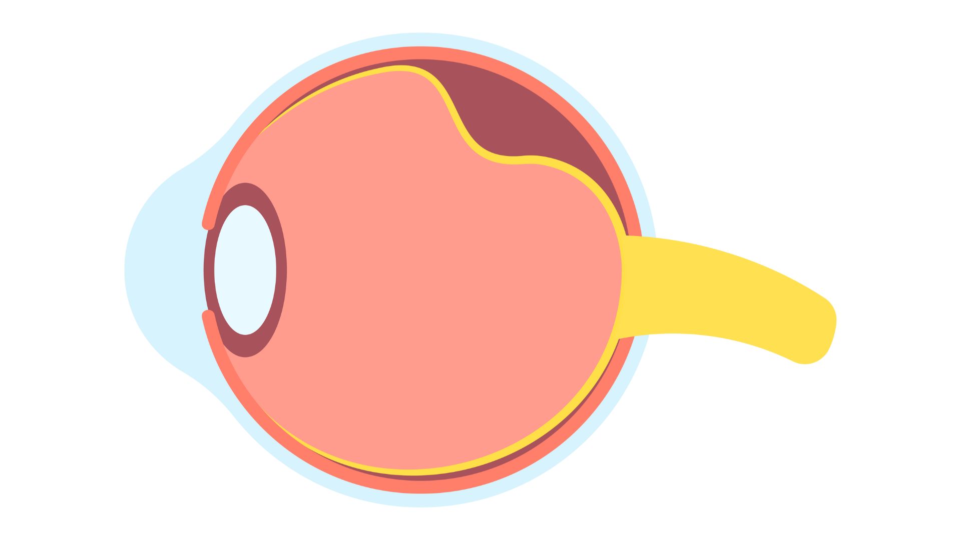 descolamento de retina