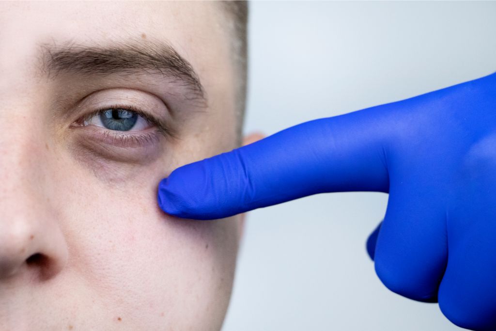blefaroplastia inferior