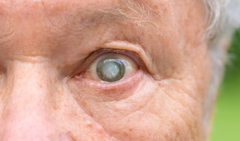 Catarata nos olhos: quais são os tratamentos?