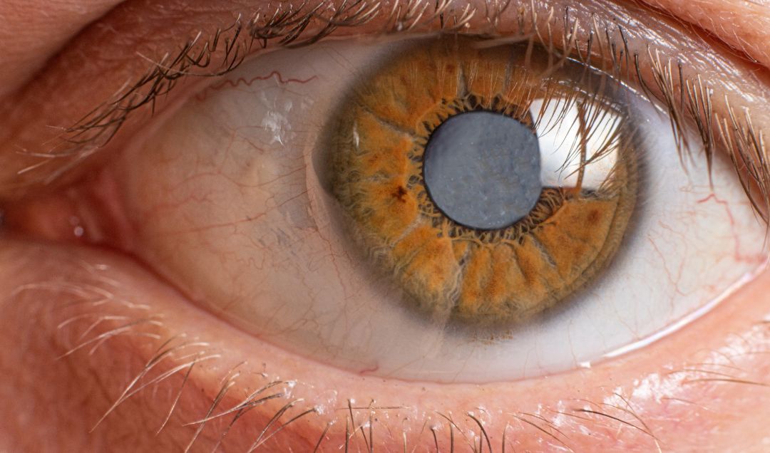 Cirurgia de catarata: tudo o que você precisa saber