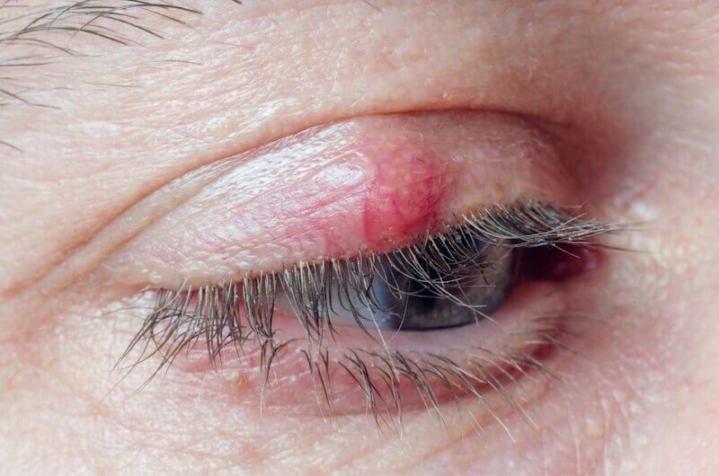 Imagem de um olho humano com um calázio visível na pálpebra superior, indicando uma infecção ocular comum. A imagem destaca detalhes da pele, cílios e o olho em close.