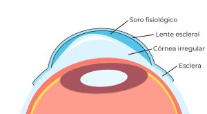 lente escleral detalhada