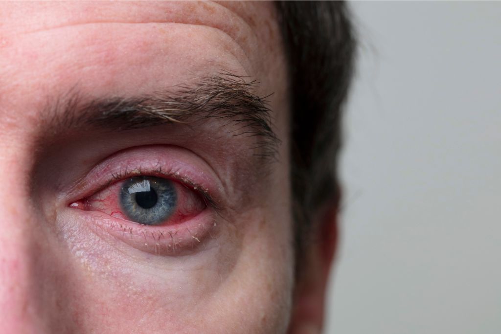 Olhos vermelhos: o que pode ser?