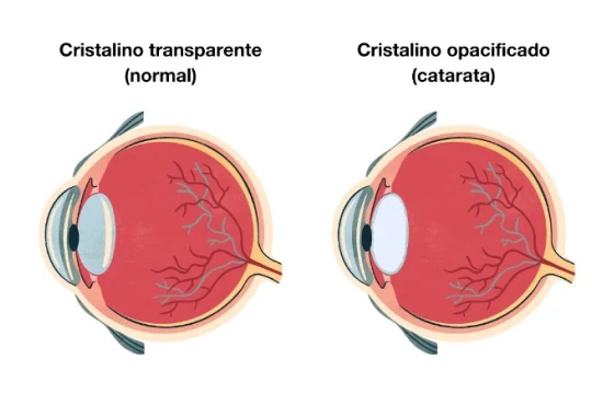 Ilustração comparativa do cristalino normal e do cristalino com catarata, evidenciando as diferenças entre os dois estados. O lado esquerdo mostra o cristalino transparente, enquanto o direito revela o cristalino opacificado.