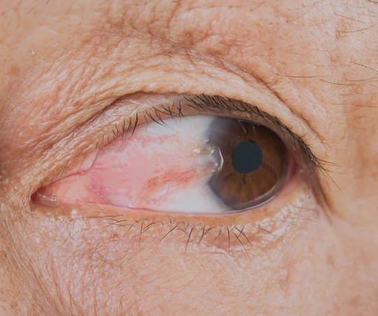 Olho humano com aparência anormal mostrando riscos de saúde ocular. A imagem destaca lesões, possível irritação ou condição médica. Importante cuidar da saúde visual.