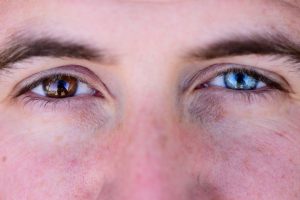 Heterocromia completa