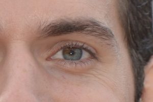 Heterocromia setorial