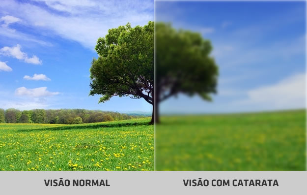 Sintomas da catarata - como sei se tenho